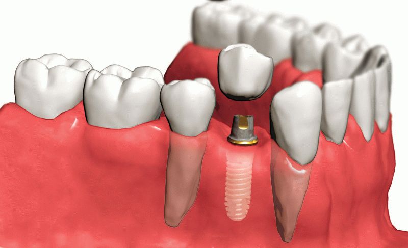 Имеют ли зубные импланты плюсы и минусы