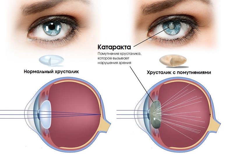 Что представляет собой катаракта