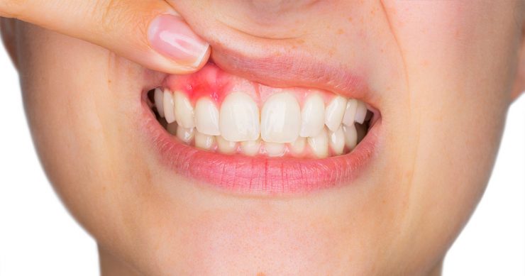 Как лечится абсцесс зуба