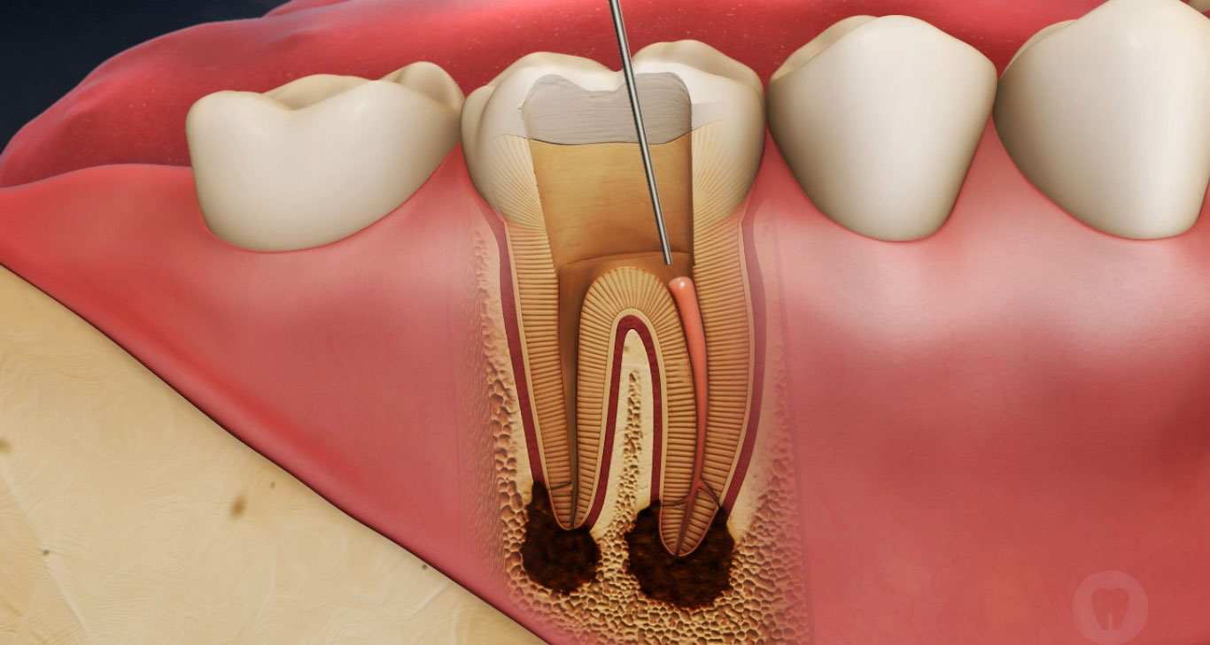 Как диагностировать абсцесс зуба