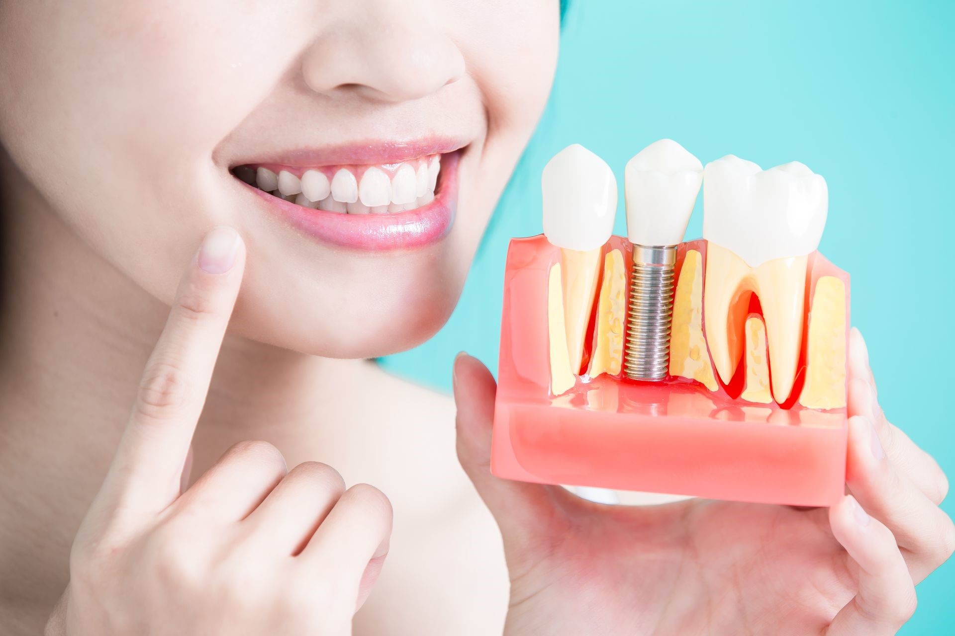 Правильный уход за имплантами зубов
