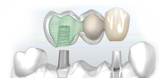 лазерная имплантация зубов