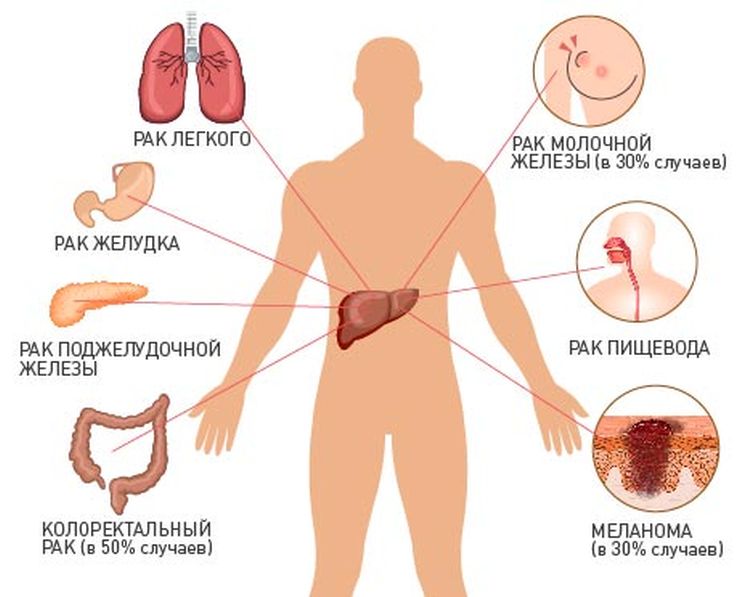 метастазы в печени при раке груди