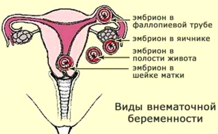 обильные месячные внематочная беременность
