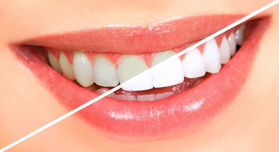 Современные методы отбеливания зубов дома