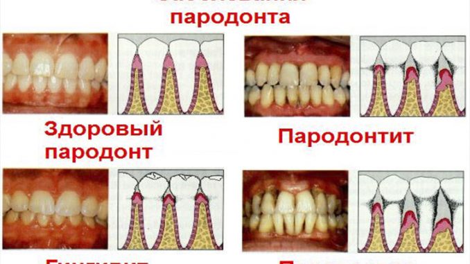 Как определить пародонтоз