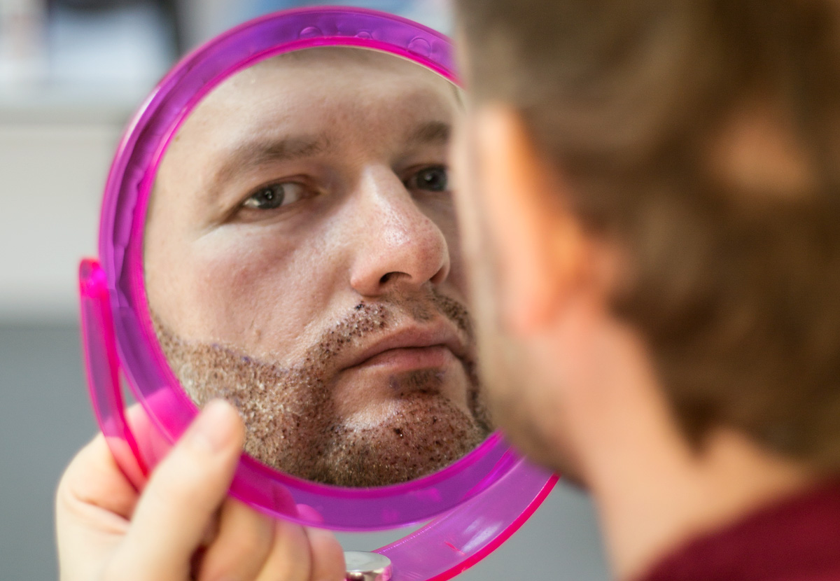 Как делается пересадка волос на бороду