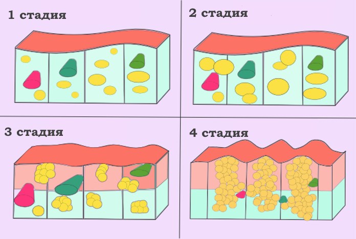 Как определить стадии целлюлита